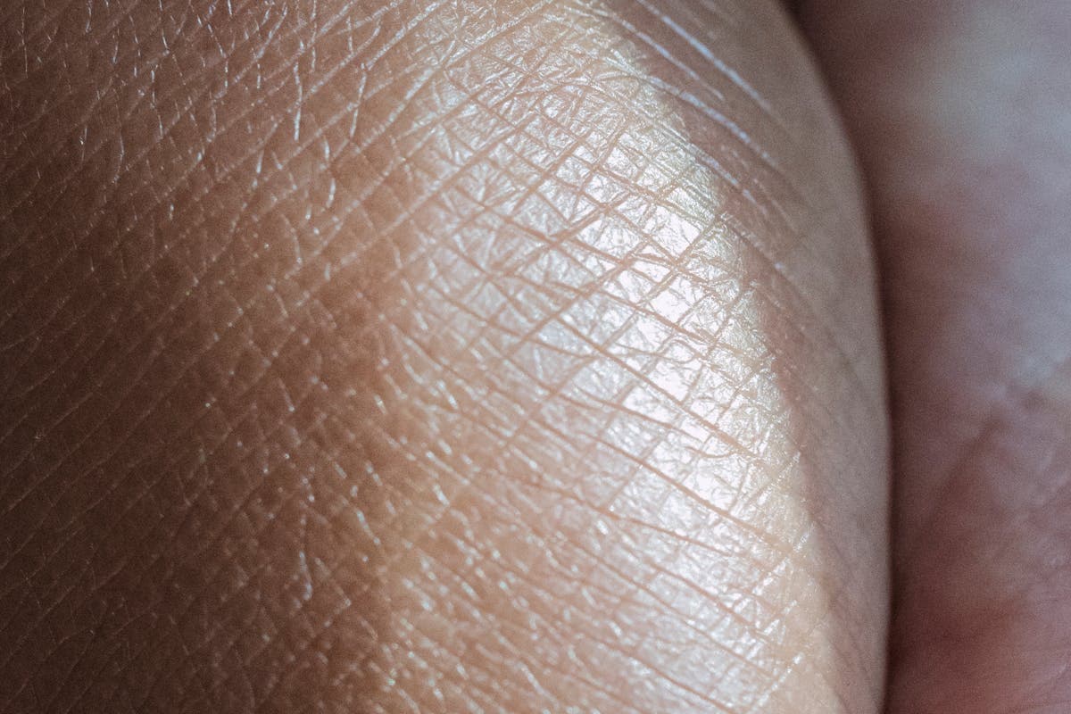 Summer Hives and Itchy Skin: Antihistamines and Creams